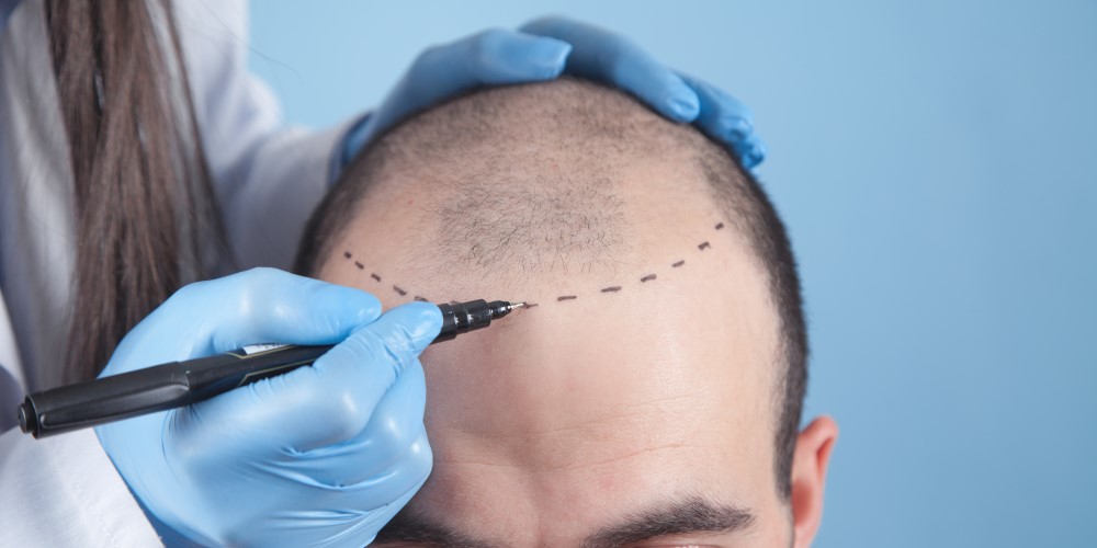 Concert to seek approval for hair loss drug after second study success